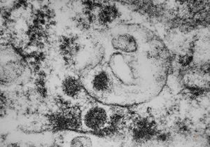 M,2y. | viral particles ? in hepatocyte M,2y. | viral particles ? in hepatocyte